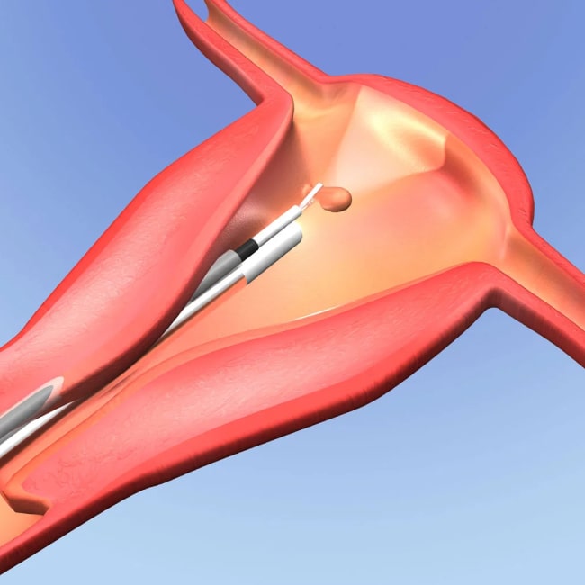 Υστερεκτομή